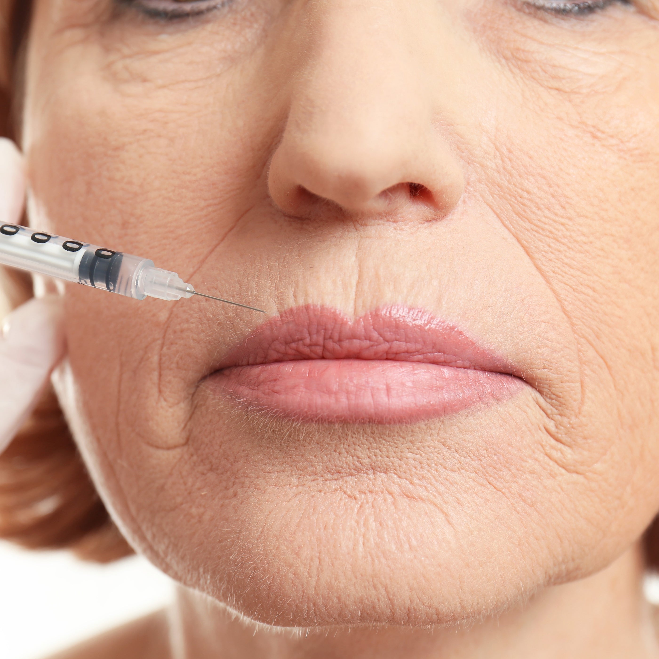 Mouth Wrinkles Botulinum Toxin Treatment — Skinview Medical Aesthetics